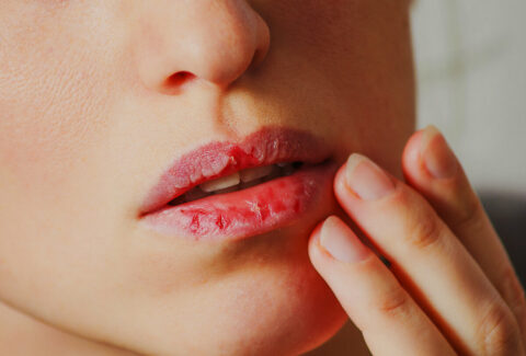 Чем лечить трещинки в уголках губ?