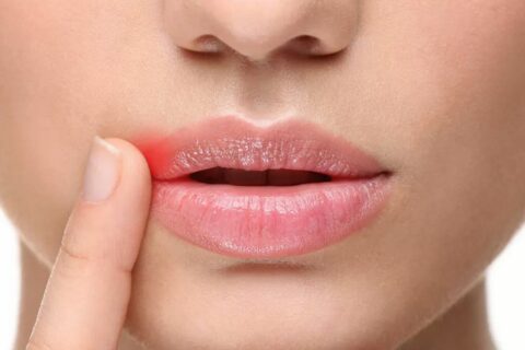 Причины трещин в уголках губ